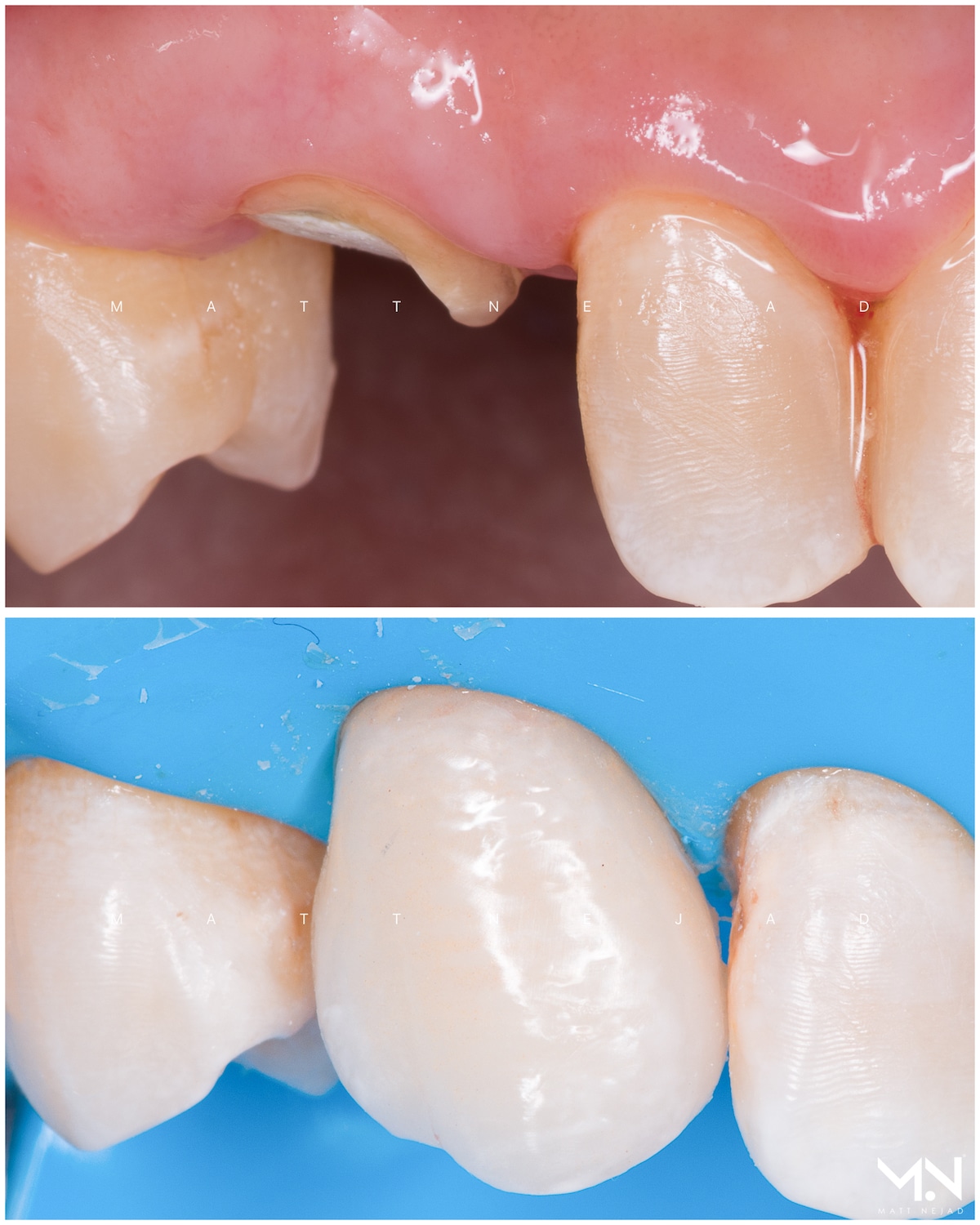 Biomimetic restoration - Build-up and Crown