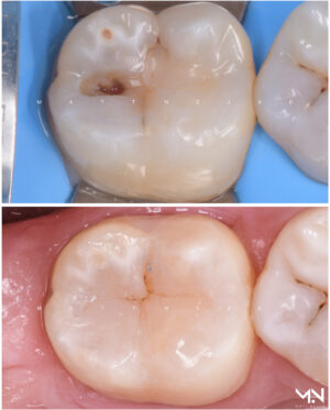 Biomimetic Composite restoration