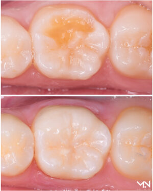 Biomimetic restoration - Ceramic Onlay