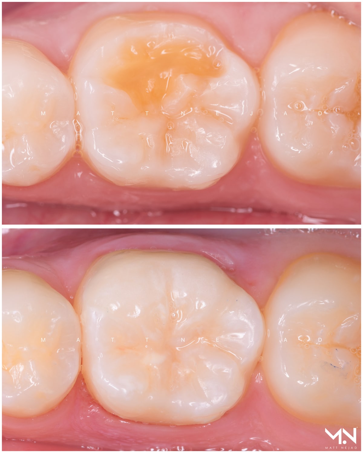 Biomimetic restoration - Ceramic Onlay