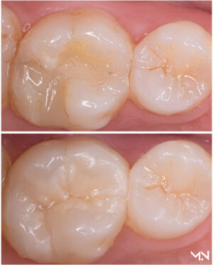 Biomimetic restoration - Ceramic Inlay