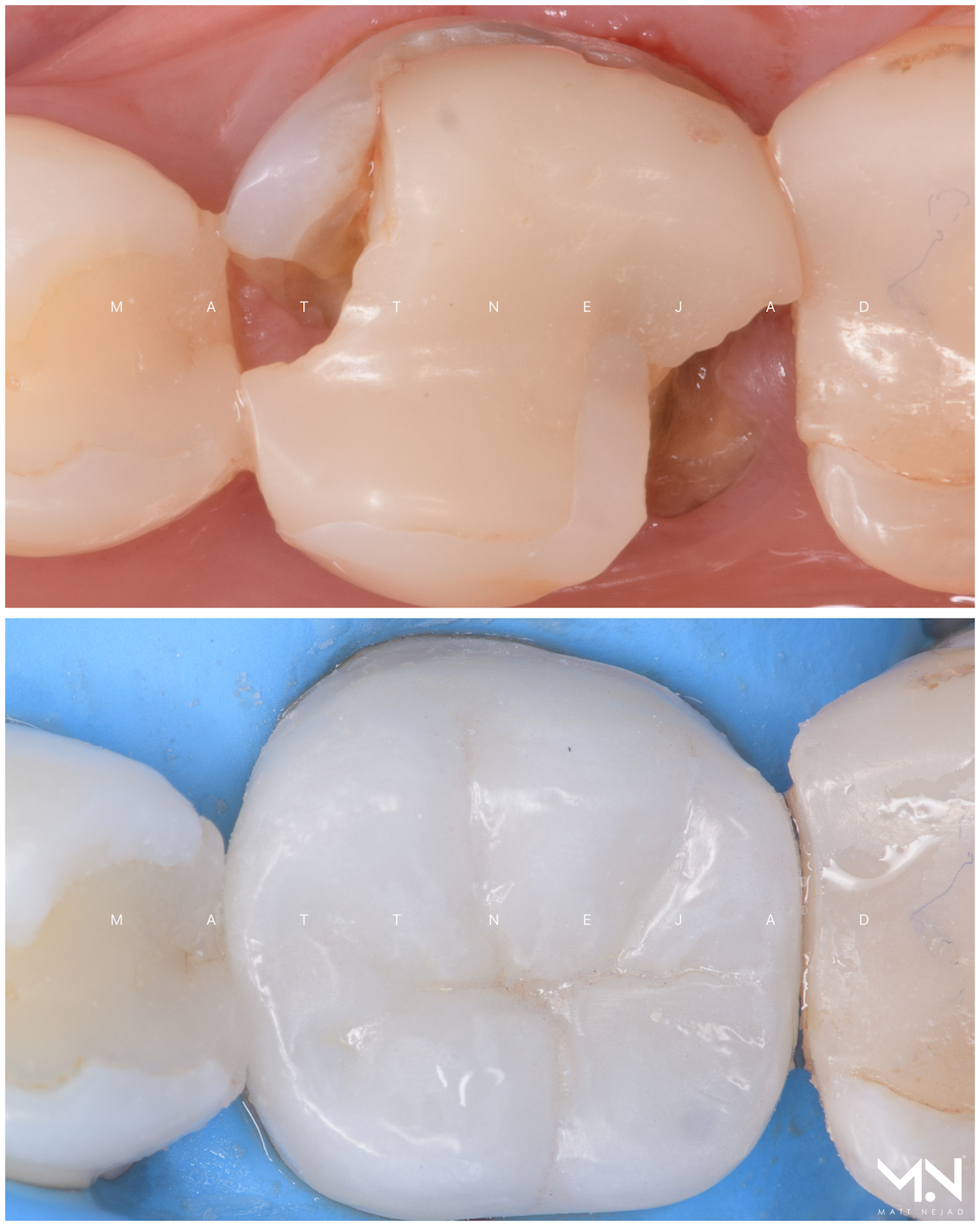 Biomimetic restoration - Ceramic Onlay