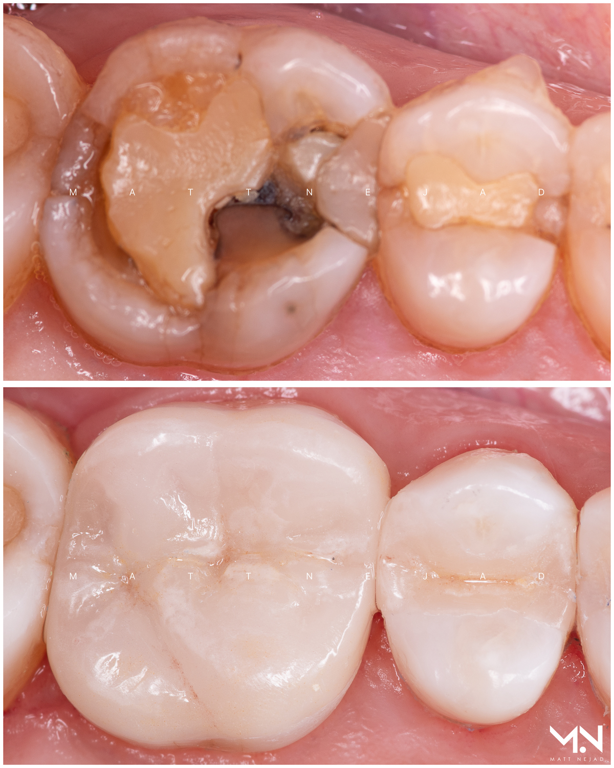 Biomimetic restoration - Ceramic Inlay & Onlay