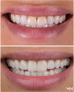 Closeup before & after #26- 2 veneers