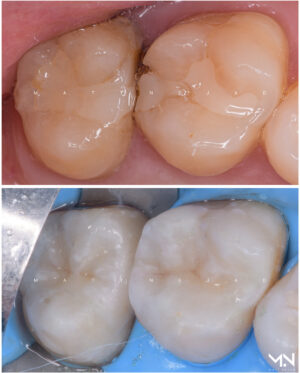 Biomimetic restoration #3 - 2 Ceramic inlays.jpg