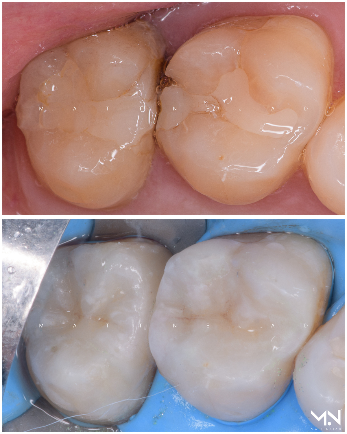 Biomimetic restoration #3 - 2 Ceramic inlays.jpg