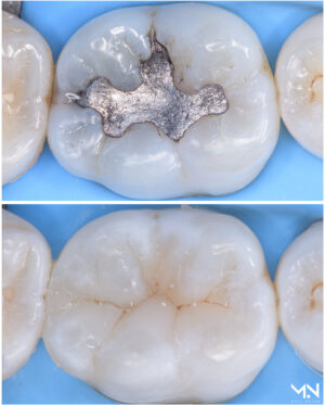 Biomimetic restoration - composite filling molar