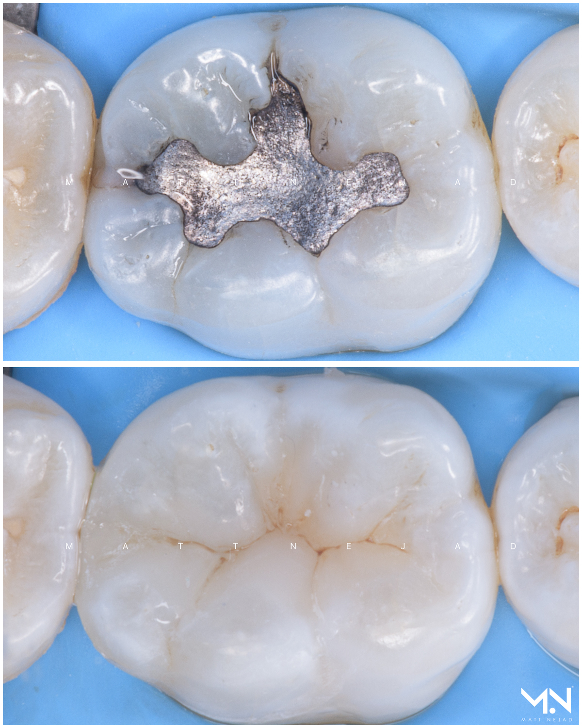 Biomimetic restoration - composite filling molar