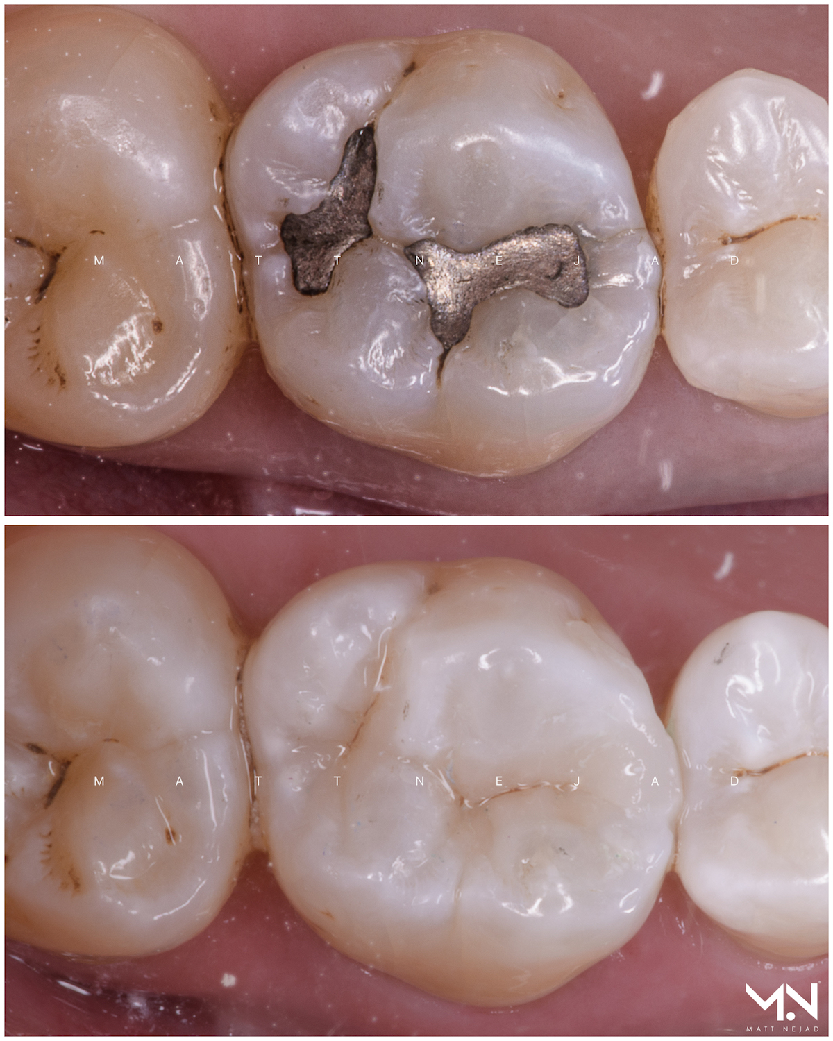 Biomimetic restoration - composite filling maxillary molar