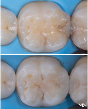 Biomimetic restoration - composite filling