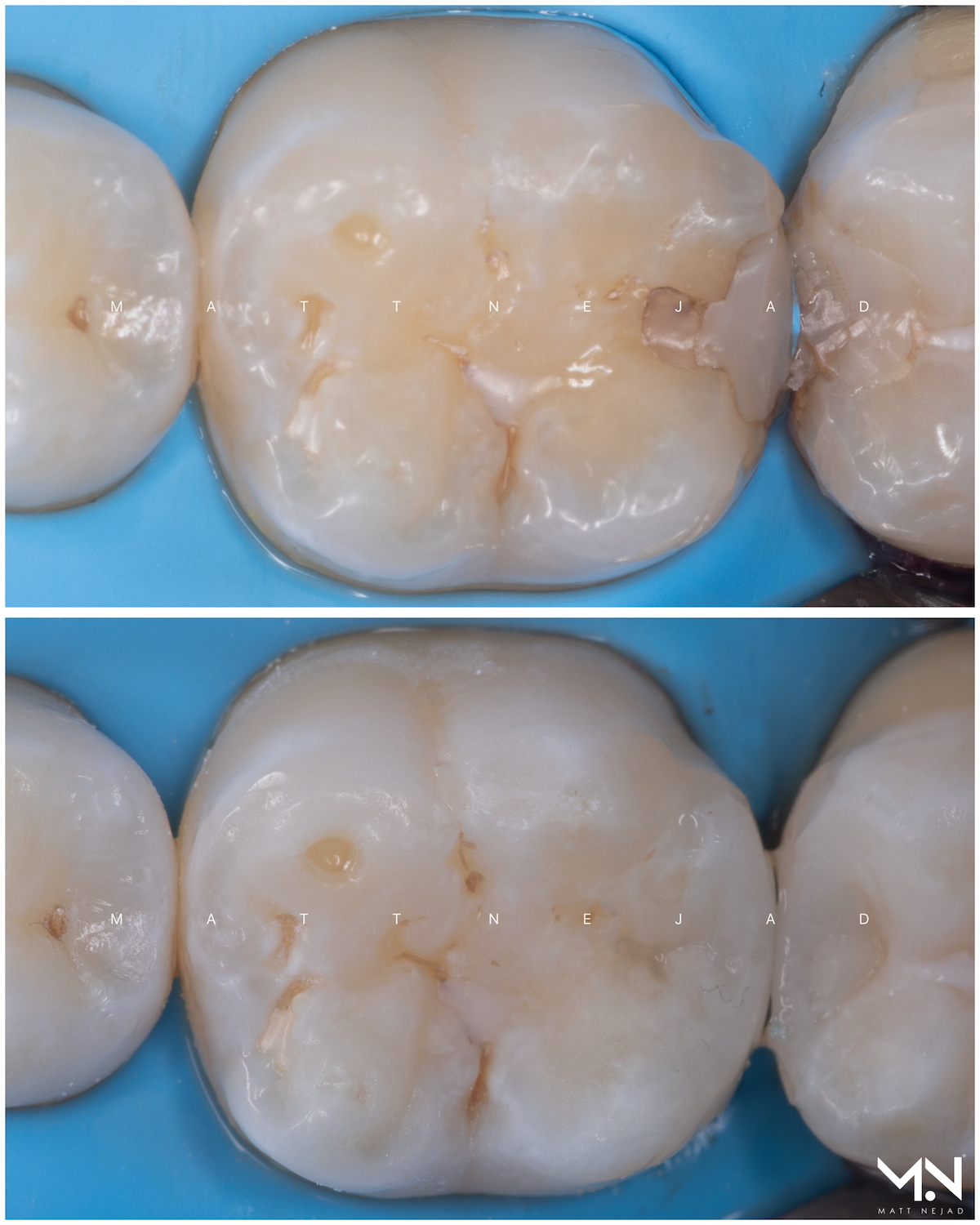 Biomimetic restoration - composite filling