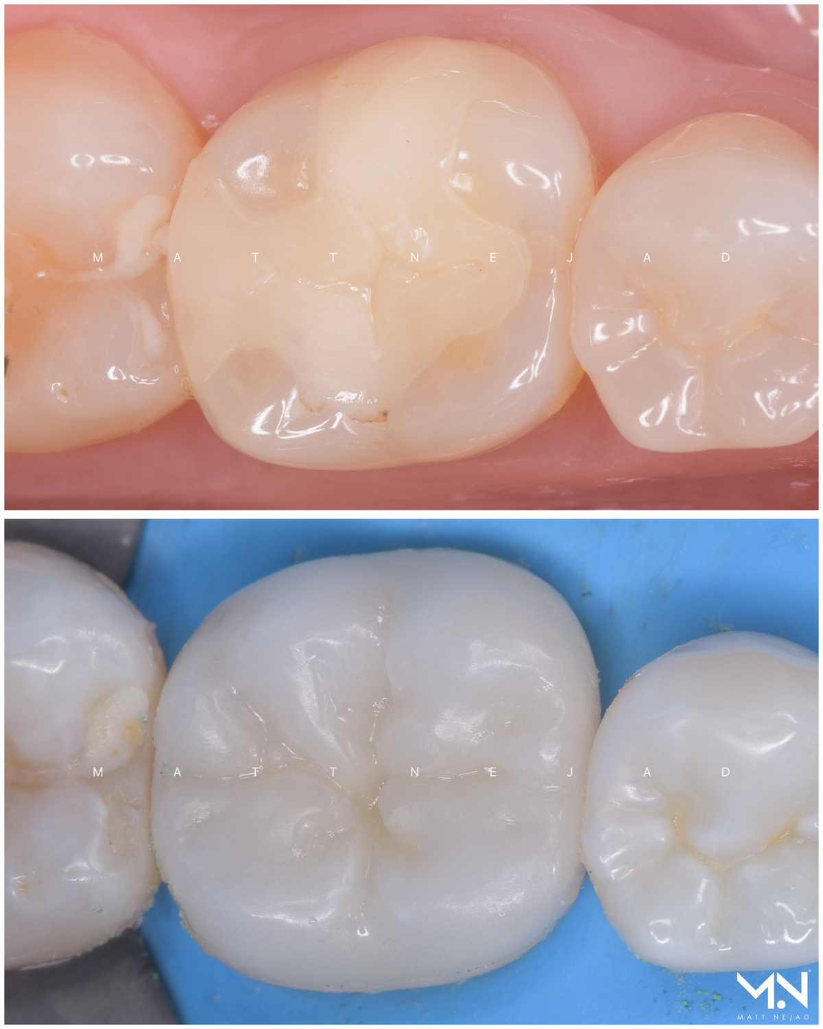 Biomimetic restoration - ceramic onlay