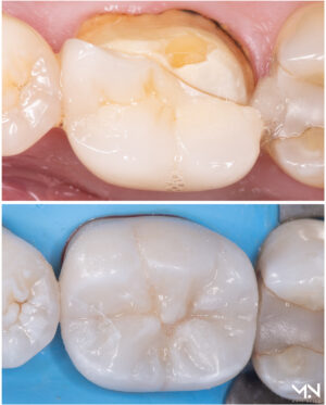 Biomimetic restoration #2 - Ceramic crown