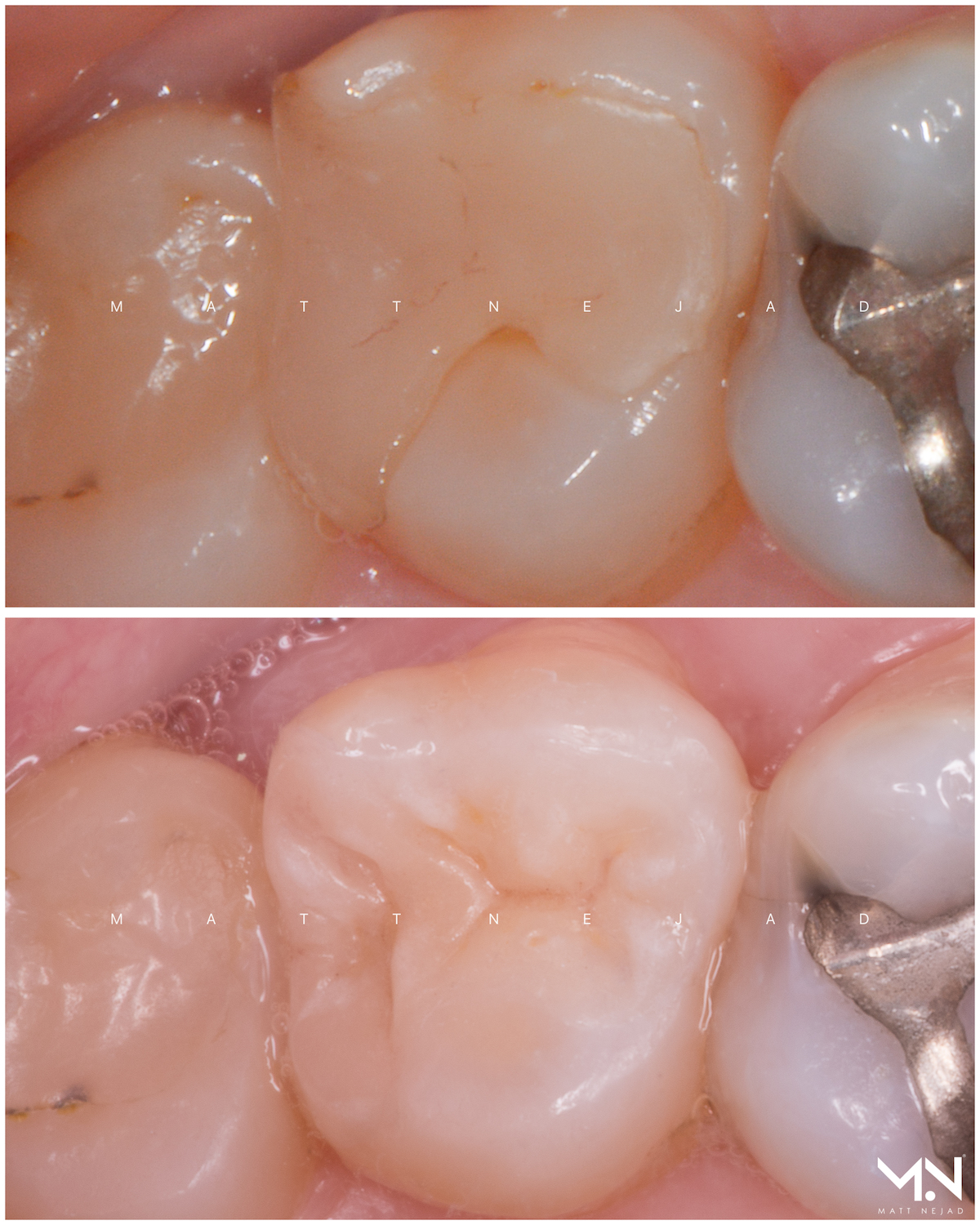 Biomimetic restoration- Ceramic inlay