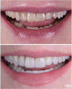 Closeup before & after- 20 veneers