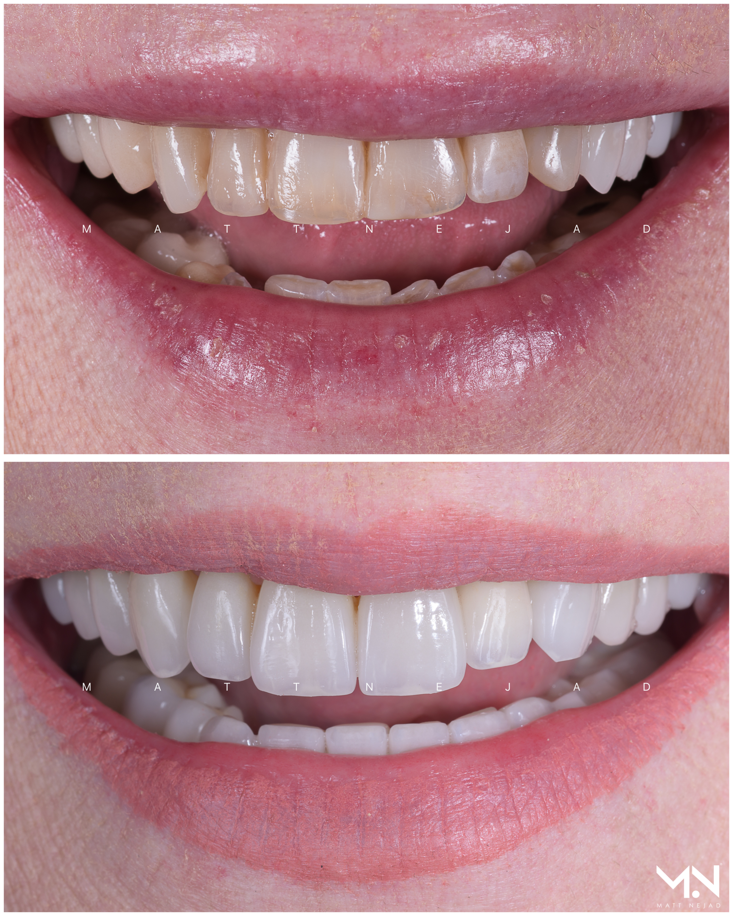 Closeup before & after- 20 veneers