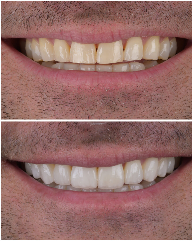 Closeup before & after 36 10 Veneers Closeup before & after 36 10